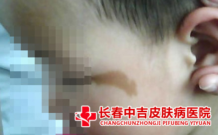 咖啡斑症状
