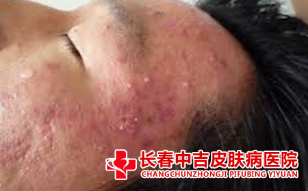 痤疮的症状
