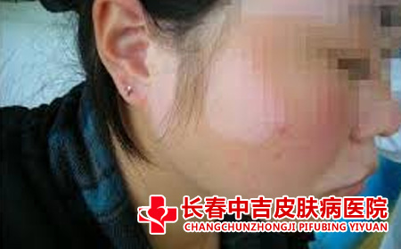 白癜风症状