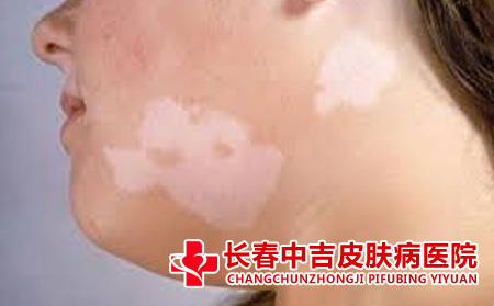 白癜风的症状
