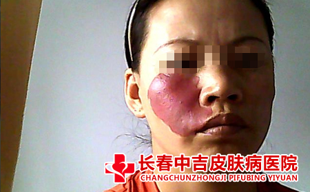 红胎记怎样去除