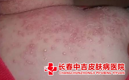 湿疹症状