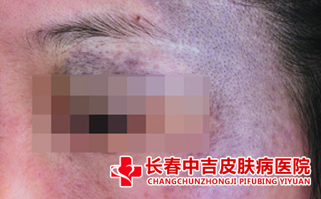 太田痣的病因