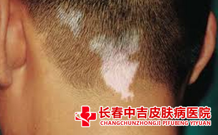 白癜风病因有哪些