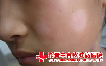 白癜风患者在饮食方面有哪些禁忌