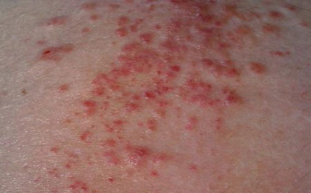 背部湿疹的症状有哪些