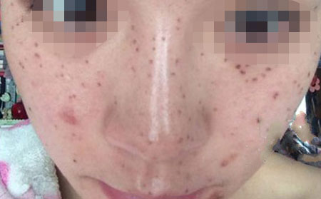 正确的去除雀斑得方法