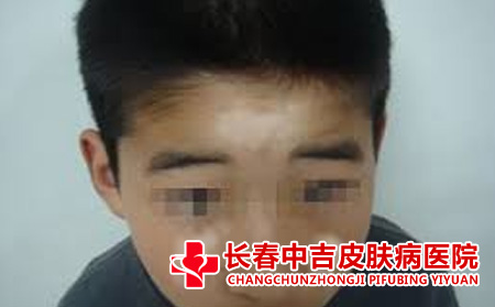 青少年白癜风症状有哪些