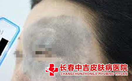 影响太田痣的因素