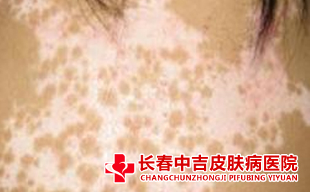 老年人白癜风症状