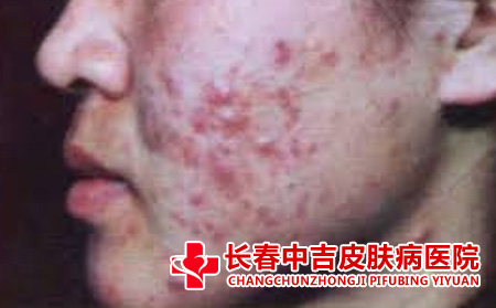面部痤疮的治疗方法