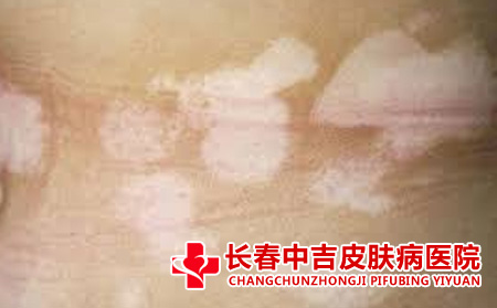 白癜风症状