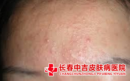 爱长痤疮的部位