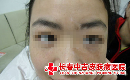 怎样诊断白癜风