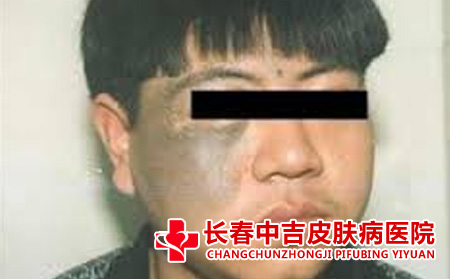 太田痣的病因