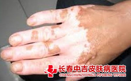 老年人白癜风的危害