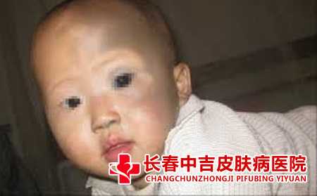 太田痣会遗传吗