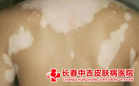 怎样预防白癜风复发