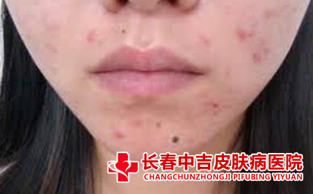 面部痤疮怎么治疗
