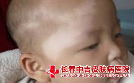 白癜风症状