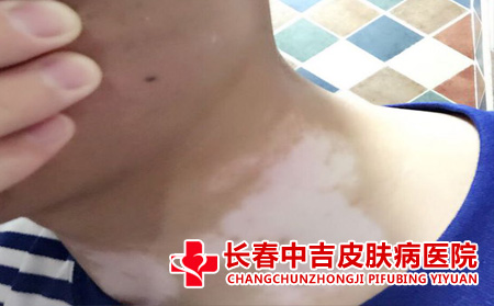 白癜风症状