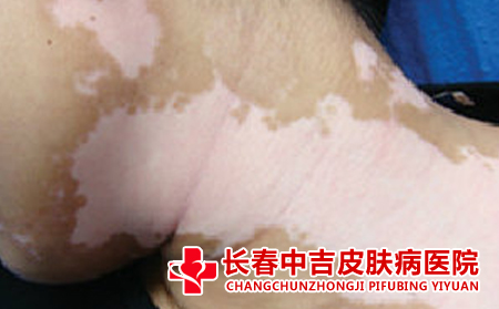 怎样远离白癜风的危害