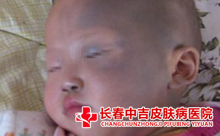 太田痣给宝宝带来的危害
