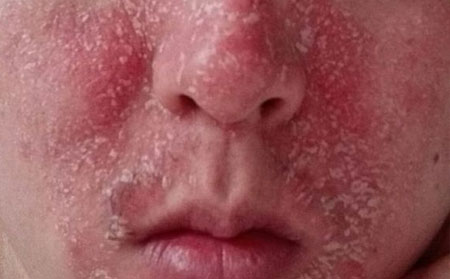 银屑病的危害有什么