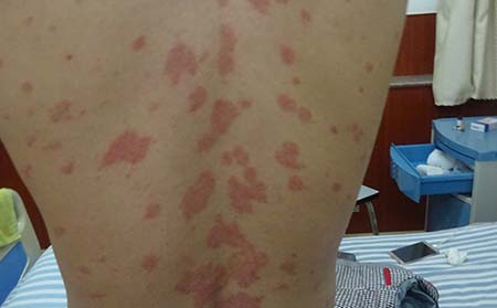 银屑病怎么治疗