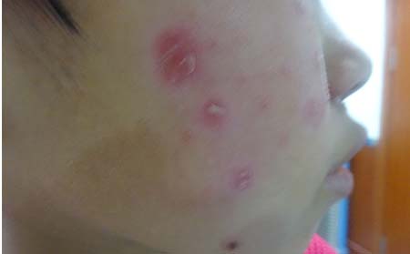银屑病患者护理方法