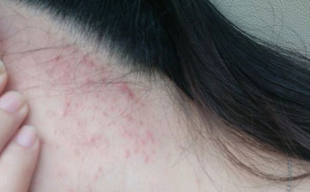 诱发痘痘的原因