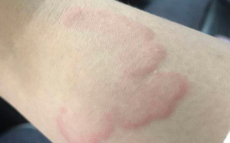 荨麻疹的症状有什么