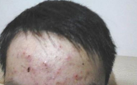 痤疮的原因有什么