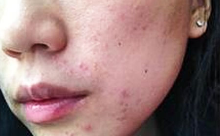 皮炎的治疗方法