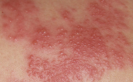 湿疹的危害有什么