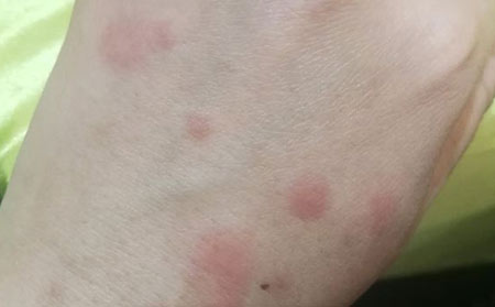荨麻疹患者的护理