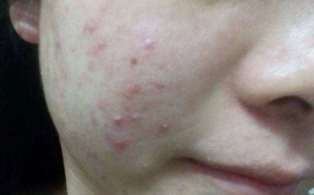 治疗青春痘的方法