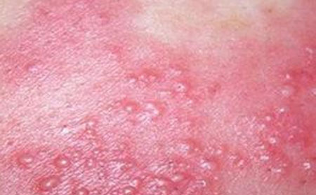 湿疹会导致什么危害