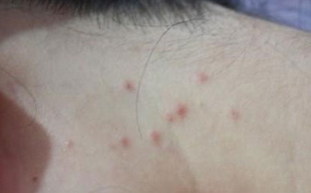 痤疮的护理方法