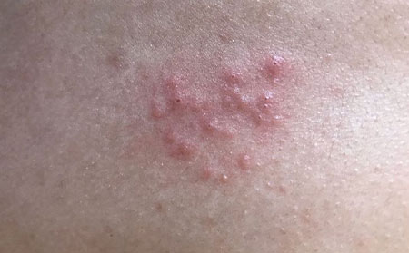 带状疱疹患者的常识