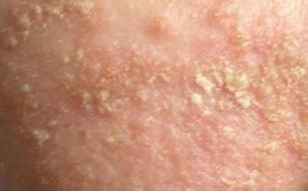 皮肤瘙痒的治疗方法