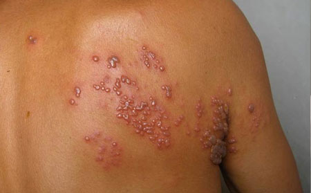 带状疱疹的危害有什么