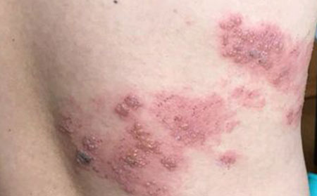 带状疱疹的护理方法
