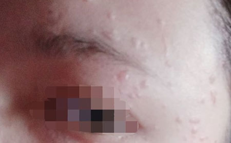 扁平疣的护理方法