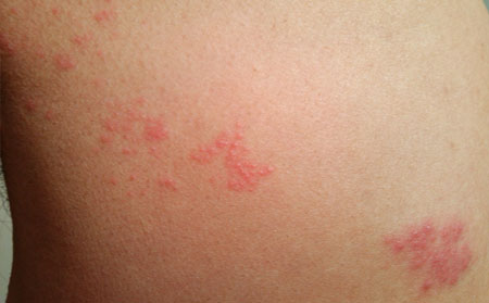 皮肤瘙痒患者护理措施