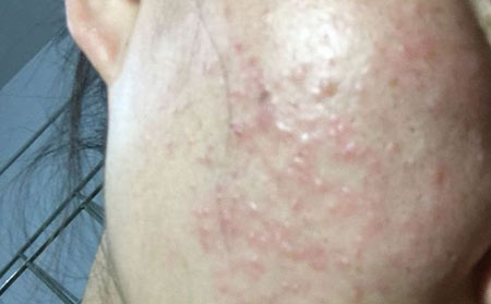 扁平疣有什么症状