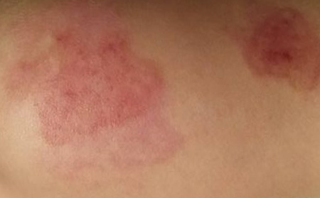 红色胎记病因,为什么长红色胎记