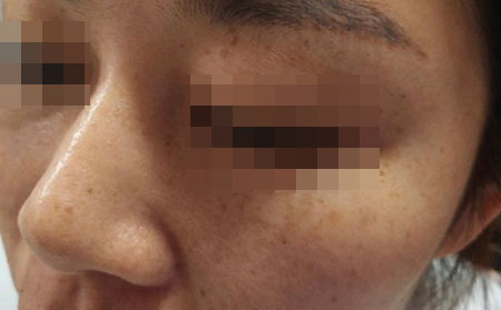 雀斑是怎么形成的