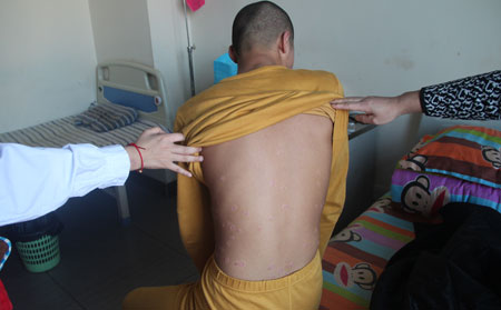 银屑病的治疗方法