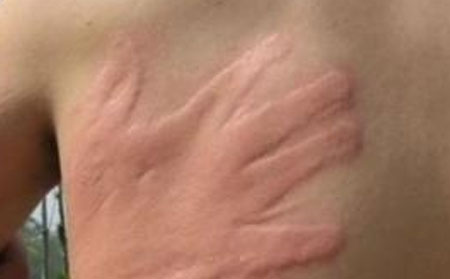 荨麻疹的护理方法